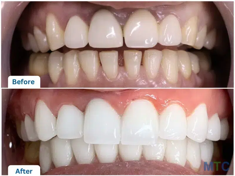 Before & After_Orthodontic Treatment