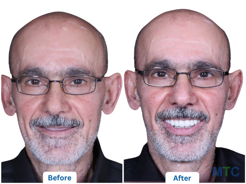 before after image of dental veneers in bangalore