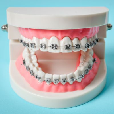 Dental Braces