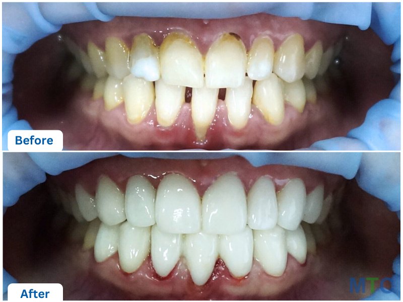 Before & After Dental Crowns