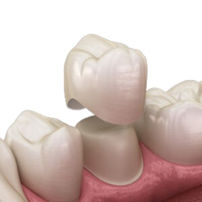 Dental Crowns