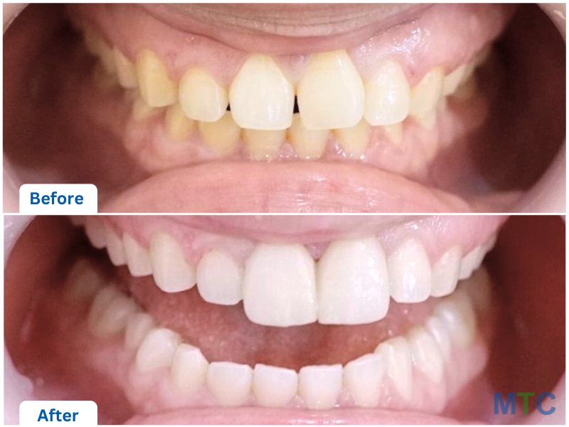 Porcelain Veneers