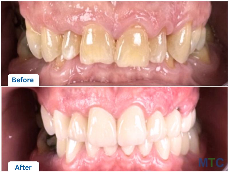 Before & After_Porcelain Crowns