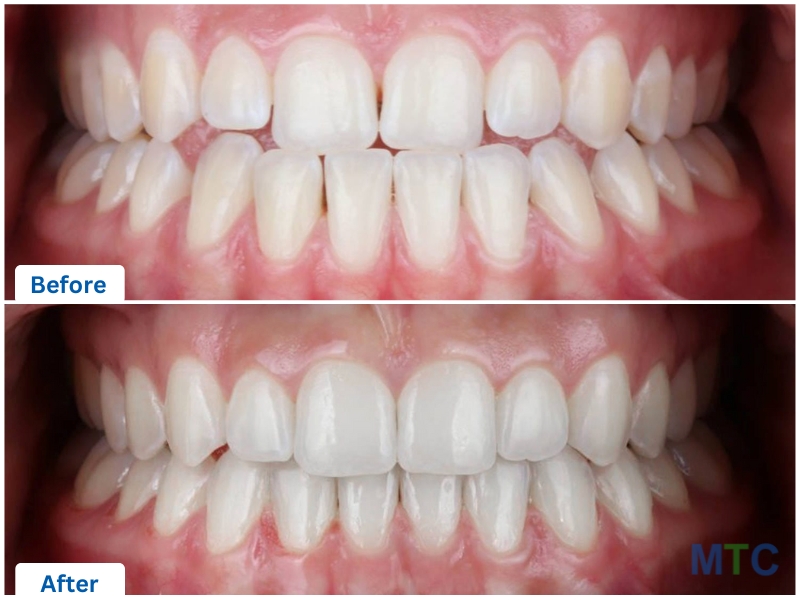 Before & After_Invisalign Treatment