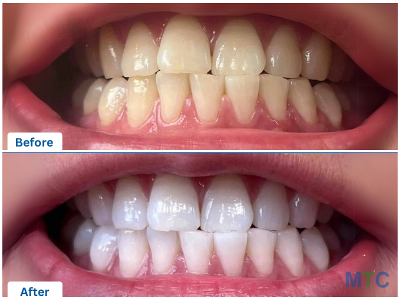 Before & After_Teeth Whitening