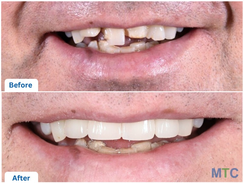 Before and after dental crowns