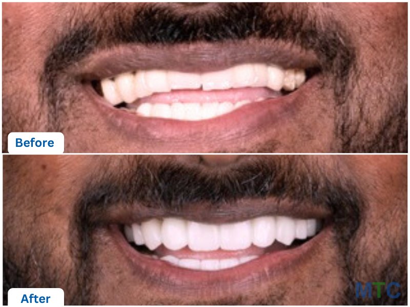 Before and after image of a patient who undertook veneer treatment at our partner clinic