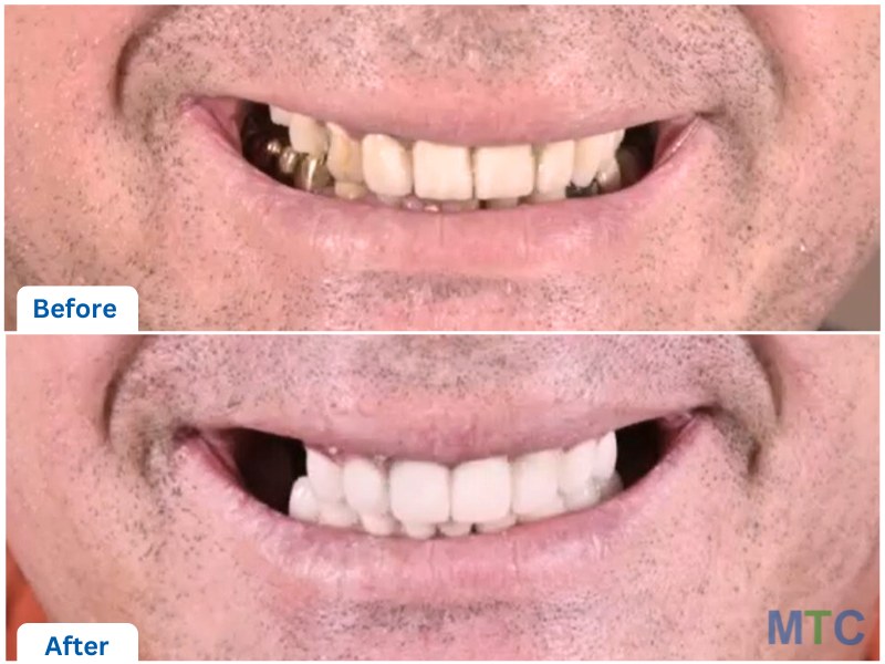 Before and after dental crowns