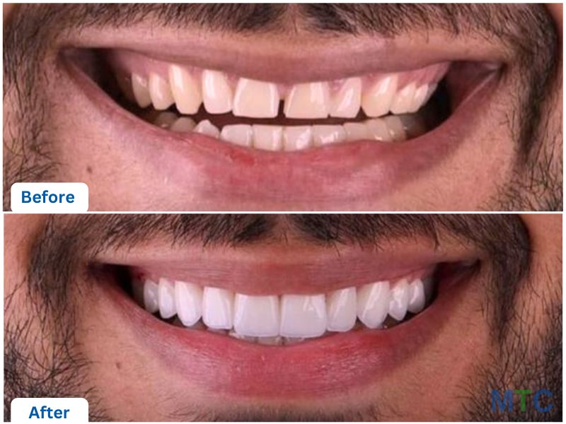 Before and after image of a patient who undertook veneer treatment at our partner clinic