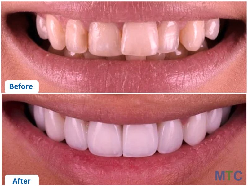 Before and after image of a patient who undertook veneer treatment at our partner clinic