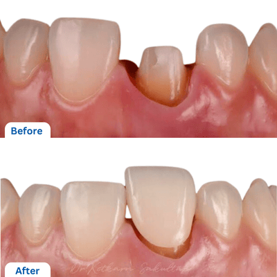 Front Teeth with Healthy Gums And Natural Shade Matching