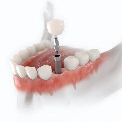 dental implants