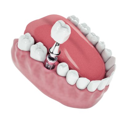 Dental Implants