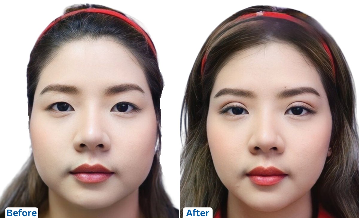 Blepharoplasty in Thailand