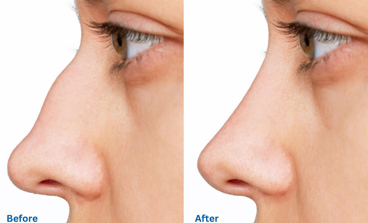 Rhinoplasty in Thailand