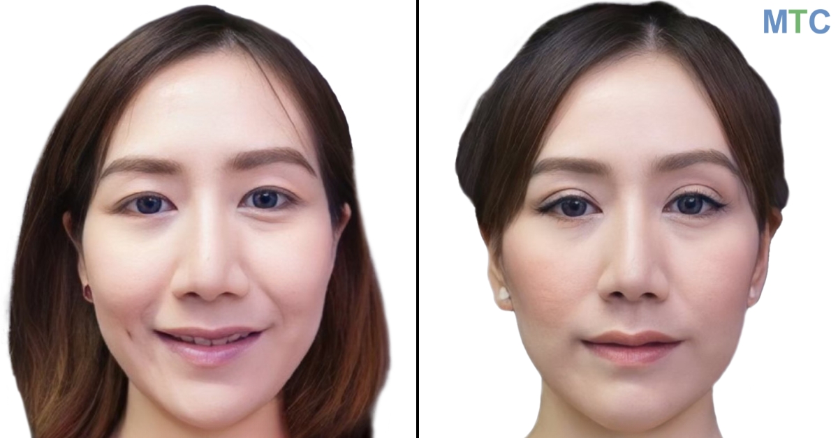 Double Eyelid Surgery or Asian Blepharoplasty in Thailand