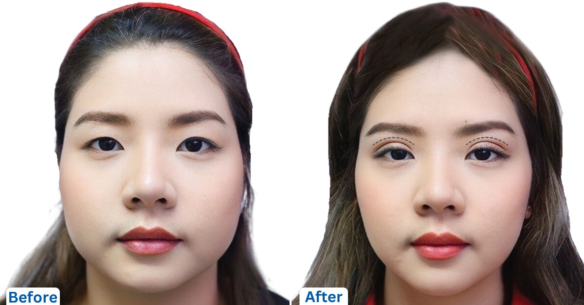 Blepharoplasty in Thailand