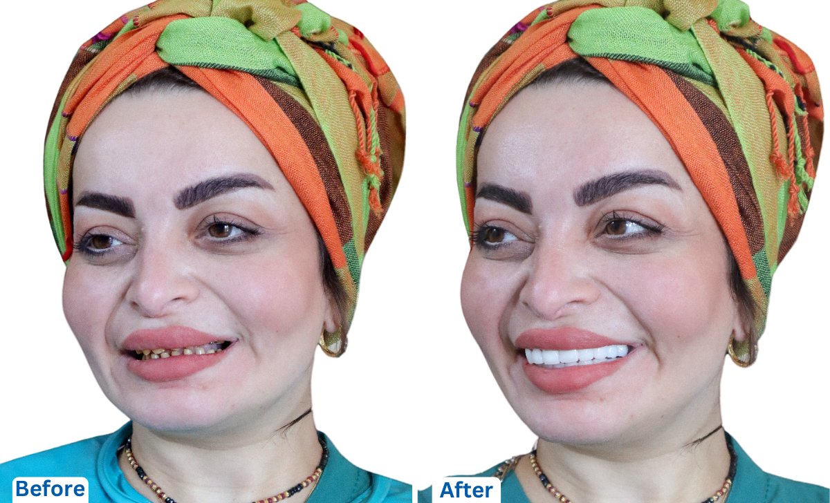 Dental Veneers in Bangalore