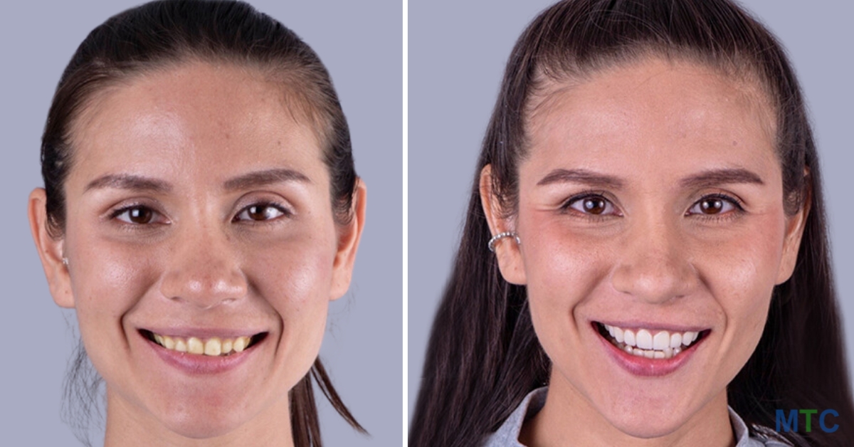 Dental Veneers in Phuket