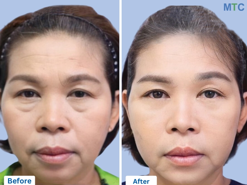 Lower Blepharoplasty