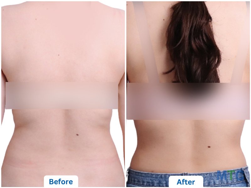 Liposuction Abd