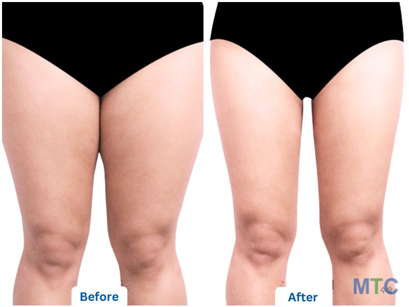 Liposuction Thigh