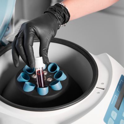 Platelet Rich Plasma Preparation