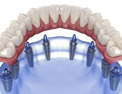 all on 8 dental implants