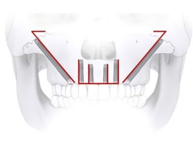 zygomatic implants