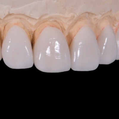 Porcelain Veneers