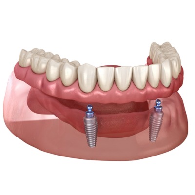 Diagrammatic representation of 2-implant supported denture in lower jaw