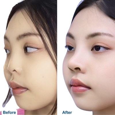 Tip Plasty Before and After