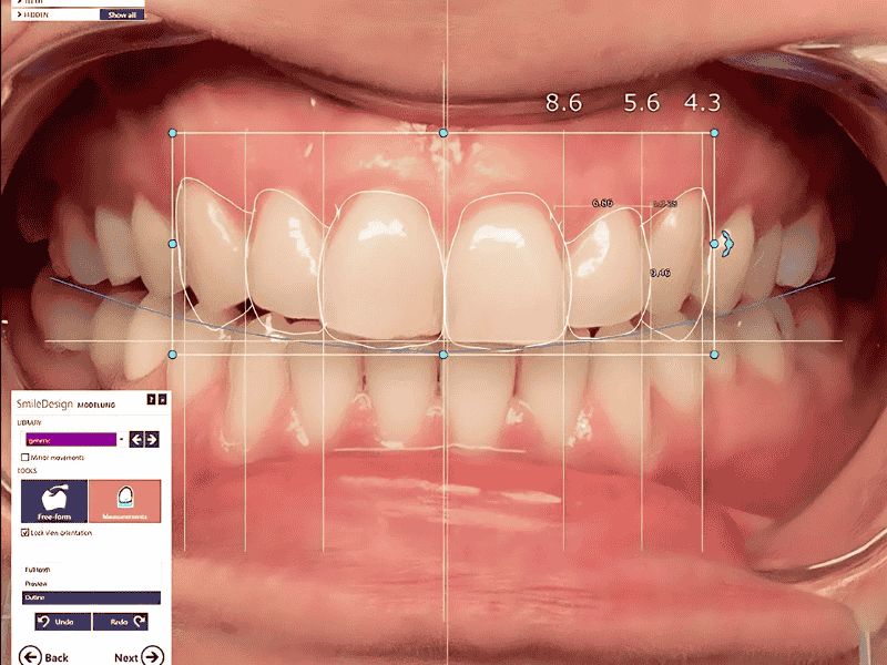 Smile Designing Software to Visualize Your Final Look Beforehand