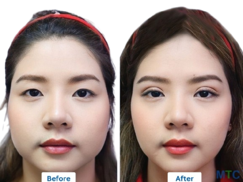 Double Eyelid Surgery