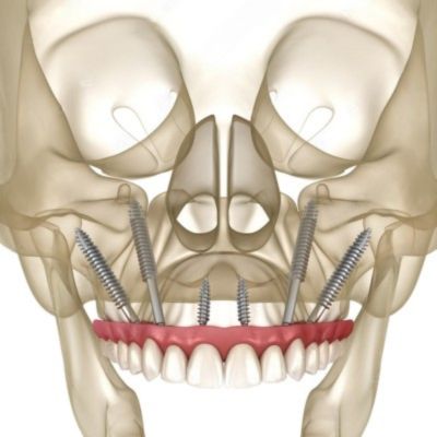 Diagrammatic representation of 6 zygomatic implants anchored in cheekbone