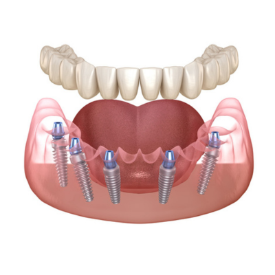 Diagrammatic representation of all on 5 dental implants in lower jaw