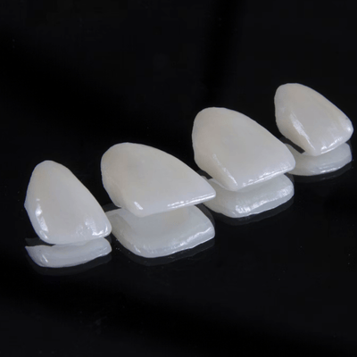 Composite Veneers