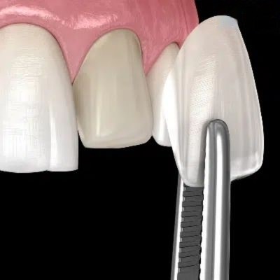 zirconia veneers