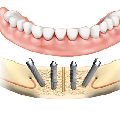 all on 4 dental implants