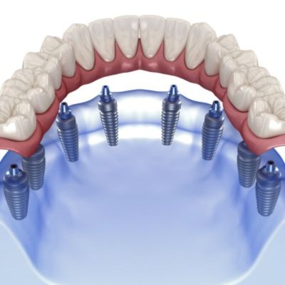 all on 8 dental implants