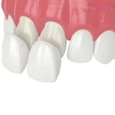 composite resin veneers