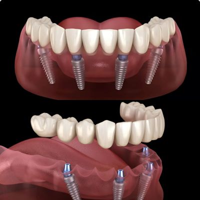 full mouth dental implants