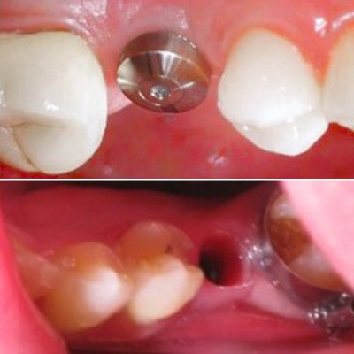 implant healing cap is placed in the implant after the osseointegration