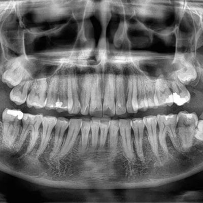 panoramic radiographs