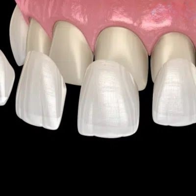 porcelain veneers