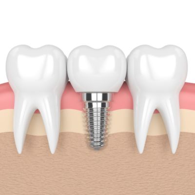 single tooth replacement 