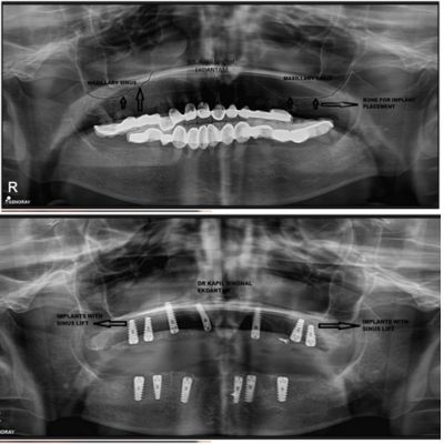 x ray of sinus lift of a patient