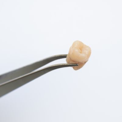 single tooth extraction