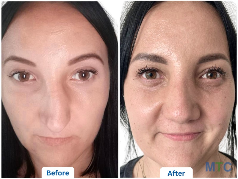 Before and after image of Rhinoplasty in KCM Clinic, Poland