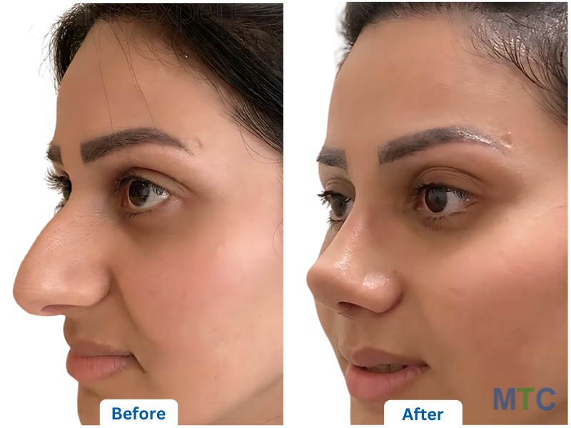 Rhinoplasty- Before and After